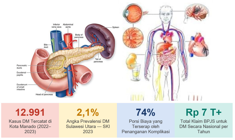 Kajian Ekonomi Penyakit Diabetes Mellitus di Kota Manado Sulawesi Utara